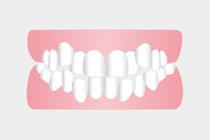 叢生（そうせい）